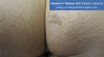 Birthmarks. Before treatment photo -  buttock, patient 9
