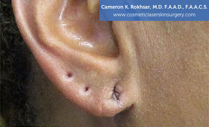 Earlobes. Before Treatment photo, female - right side view, patient 1