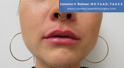 Lip Enhancement - After Treatment Photo, front view - female patient 2