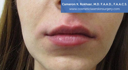 Lip Enhancement - After Treatment Photo, front view - female patient 1