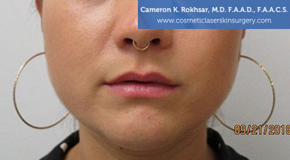 Lip Enhancement - Before Treatment Photo, front view - female patient 2
