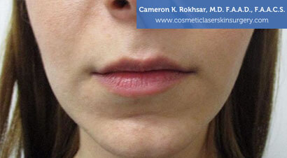Lip Enhancement - Before Treatment Photo, front view - female patient 1