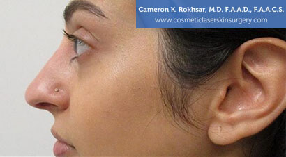 Non Surgical Nosejob - After treatment photo, female,left side view, patient 10