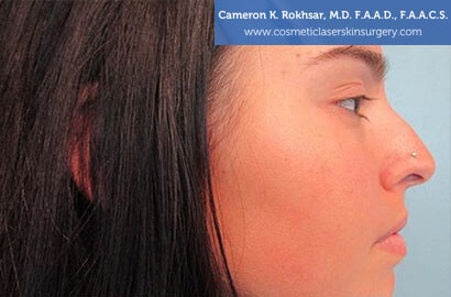 15 minute nosejob - Before treatment photo, female, right side view, patient 12