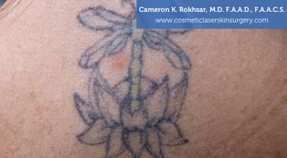 Tattoo Removal - Before and After treatment photo, female,back side view, patient 2