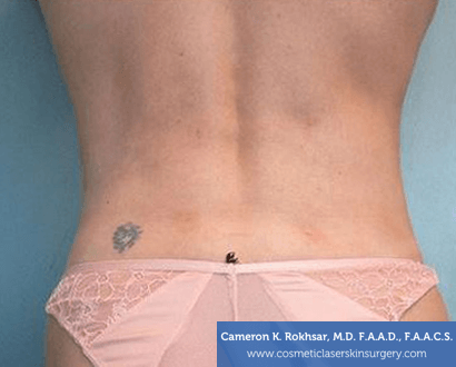 Liposuction - After Treatment Photo, back view - female patient 1