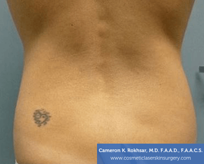 Liposuction - Before Treatment Photo, back view - female patient 1
