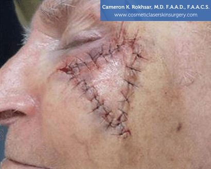 Mohs Surgery - After Treatment photo, oblique view, male patient 1