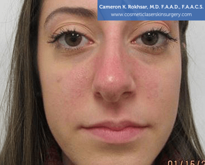 15 Minute Nosejob - After treatment photo, female, front view, patient 7