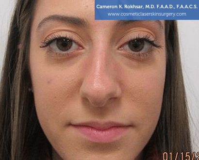 15 Minute Nosejob - Before treatment photo, female, front view, patient 7