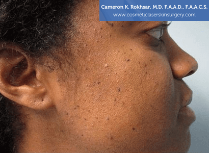 Age/Brown Spots - Before Treatment Photo: female, right side view, patient 1