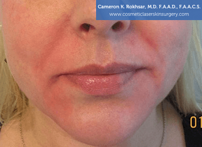 Fillers. After Treatment photo, female - front view, patient 1