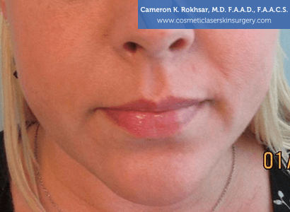 Fillers. Before Treatment photo, female - front view, patient 1