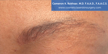 Tattoo Removal - Before treatment photo, female,left side oblique view, patient 1