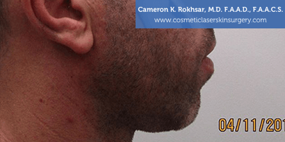 Non-Surgical Chin Job - Before Treatment photo, male - right side view, patient 1