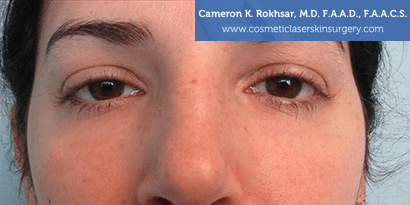 Female Patient After Non-Surgical Eye Lift - Case 07