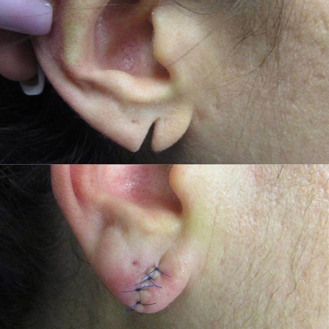Ear Hole Repair / Ear Lobe Repair / Torn Ear Repair / Ear Pasting