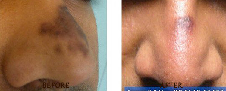 Fraxel: Before and After Treatment Photo - patient 10