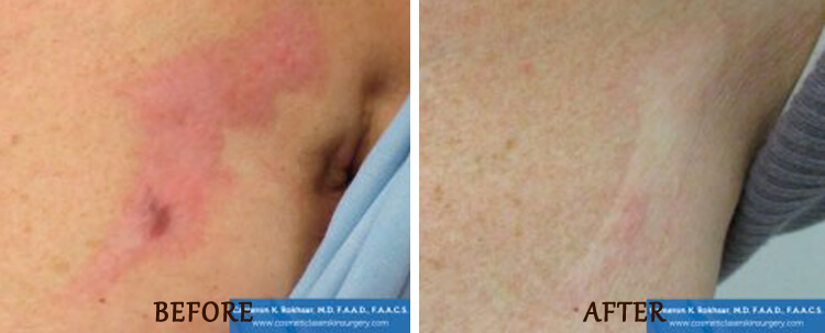 Fraxel: Before and After Treatment Photo - patient 3
