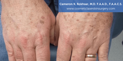 Woman's hands, Before Age/Brown Spots Treatment - patient 1