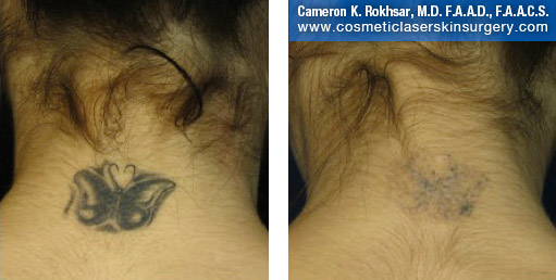 1 Laser Tattoo Removal, Remove Old Tattoos • NYC • Long Island