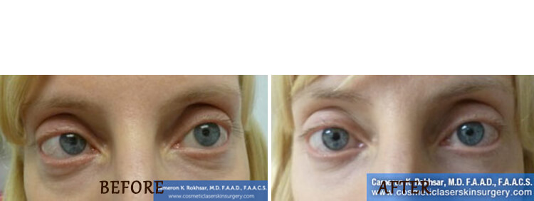 Non Surgical Eyelift: Before and After Treatment Photo - patient 2
