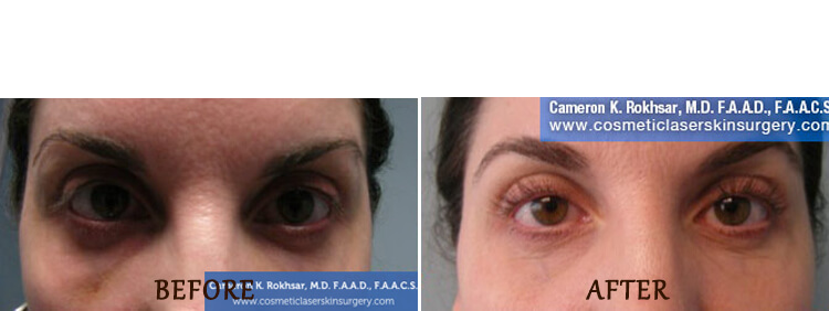 Non Surgical Eyelift: Before and After Treatment Photo - patient 3