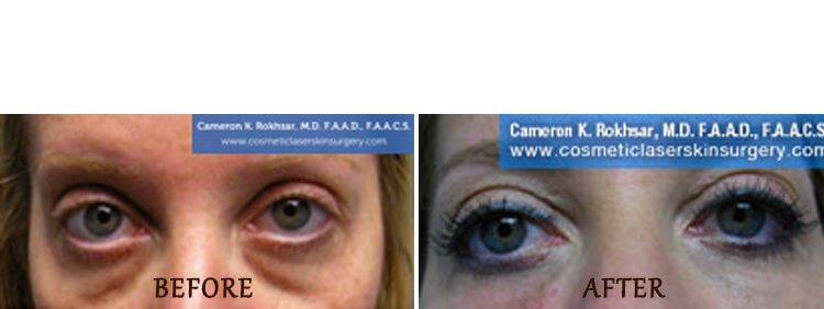 Non Surgical Eyelift: Before and After Treatment Photo - patient 6