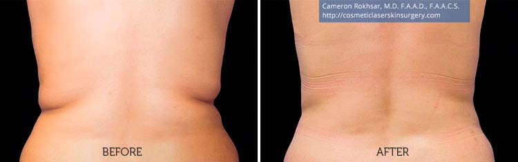 CoolSculpting Results: Before and After Treatment Photo - patient 1