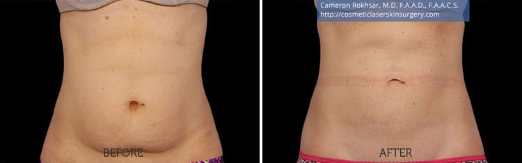 CoolSculpting Results: Before and After Treatment Photo - patient 2