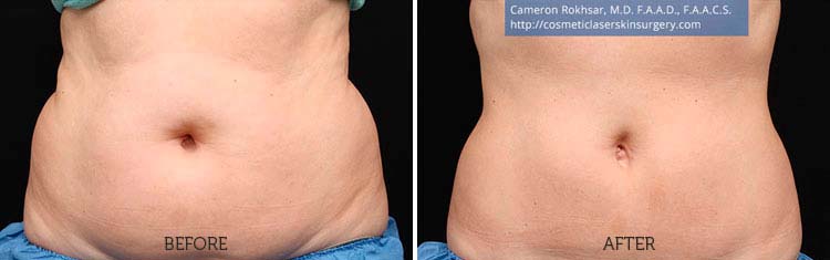 CoolSculpting Results: Before and After Treatment Photo - patient 3