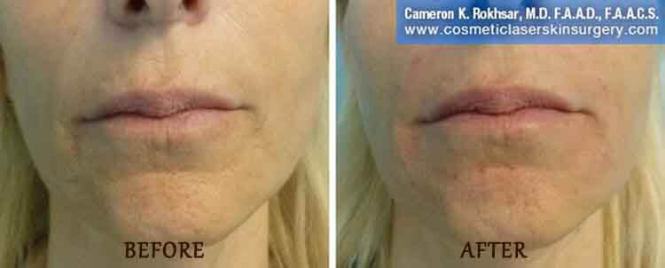 Juvederm: Before and After Treatment Photo - patient 1