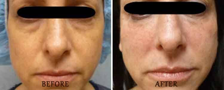 Juvederm: Before and After Treatment Photo - patient 4