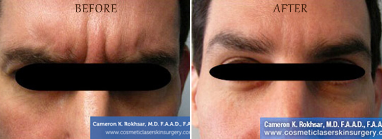 Botox: Before and After Treatment Photo - patient 2