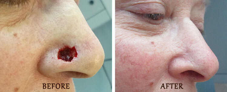 Mohs Surgery: Before and After Treatment Photo - patient 1