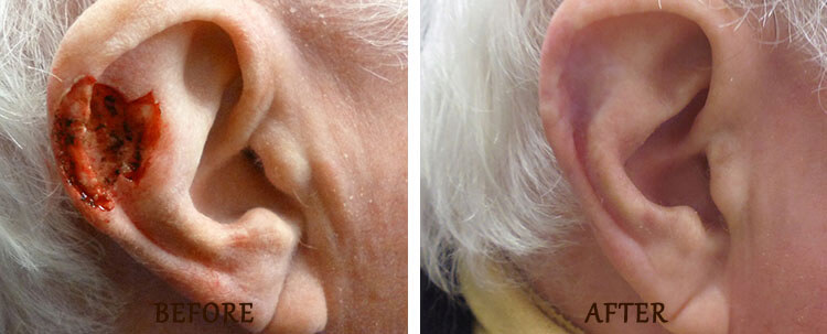 Mohs Surgery: Before and After Treatment Photo - patient 5
