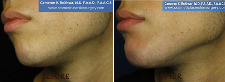 Chin Augmentation: Before and After Treatment Photo - patient 2