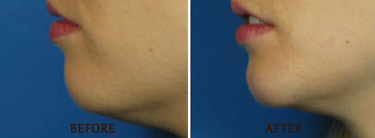 Chin Augmentation: Before and After Treatment Photo - patient 3