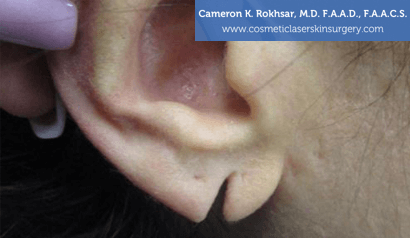 Woman's ear, Before Earlobes Treatment - front view, patient 1