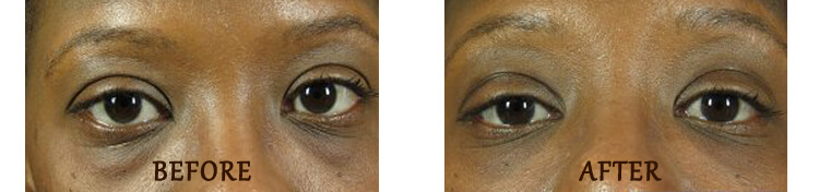 Non Surgical Eyelift: Before and After Treatment Photo - patient 1