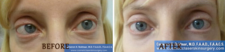 Non Surgical Eyelift: Before and After Treatment Photo - patient 4
