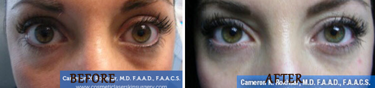 Non Surgical Eyelift: Before and After Treatment Photo - patient 5
