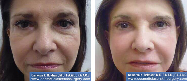Fractional CO2 Laser Treatments NYC