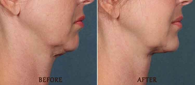 KYBELLA Results: Before and After Treatment Photo - patient 3