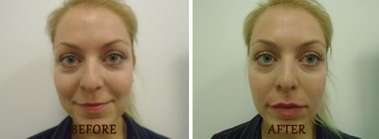 Lip Enhancement: Before and After Treatment Photo - patient 1