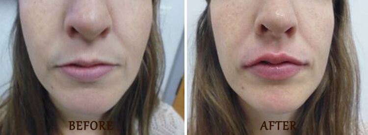 Lip Enhancement: Before and After Treatment Photo - patient 2