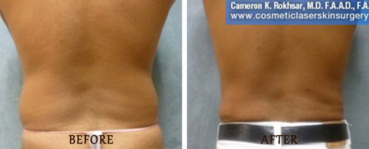 Liposuction: Before and After Treatment Photo - patient 2