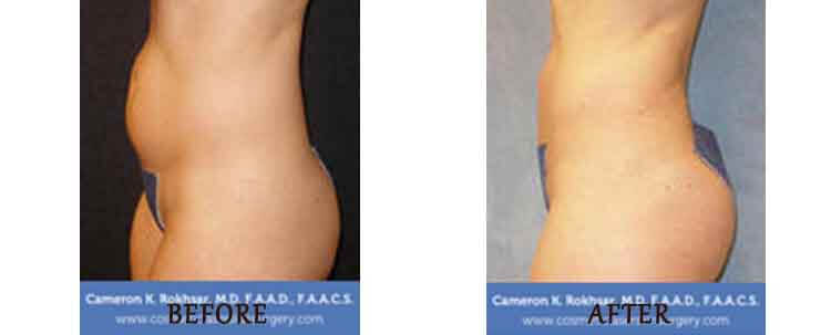 Liposuction: Before and After Treatment Photo - patient 6