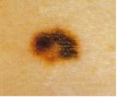 melanoma_color_differences