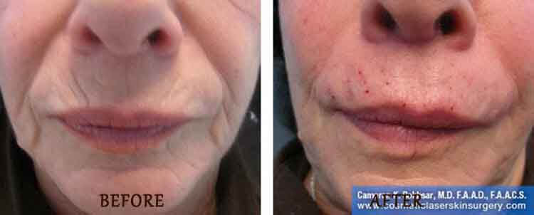 Radiesse: Before and After Treatment Photo - patient 2